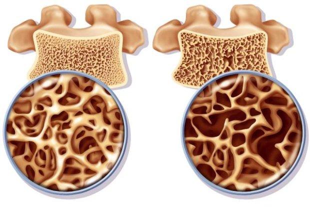 Osteoporoza Choroba Ko Ci Gowork