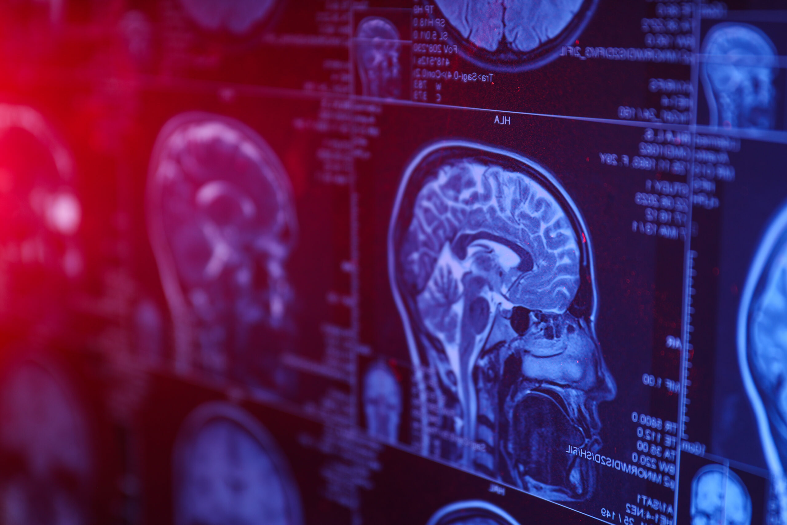 MRI or magnetic resonance imaging of the head and brain. Close u